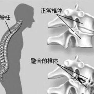 脊柱炎