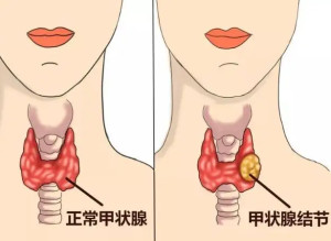 甲状腺
