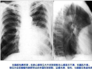胸腔积液