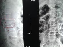 腰椎压缩性骨折